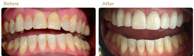 Before and after 1