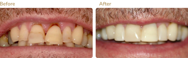 Before and after 2